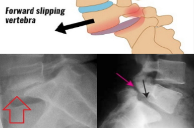 مجله گردشگری   Vertebral Slipping