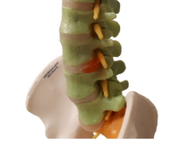  بروز القرص القطنِي                Disc herniation